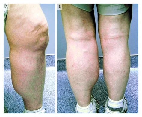 Bakers Cyst In A Patient With Rheumatoid Arthritis — Nejm