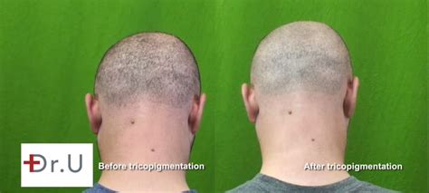 Hair Transplant Strip Surgery Scar Revision And Repair With Fue