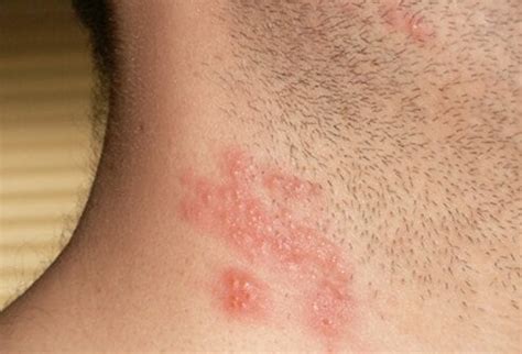 What Is the Main Cause of Shingles Rash? Signs, Symptoms, Vaccine
