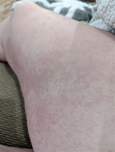 Rash On Inner Thighs F 31 Not Itchy Or Raised What Do You Think It Is Rdermatologyquestions