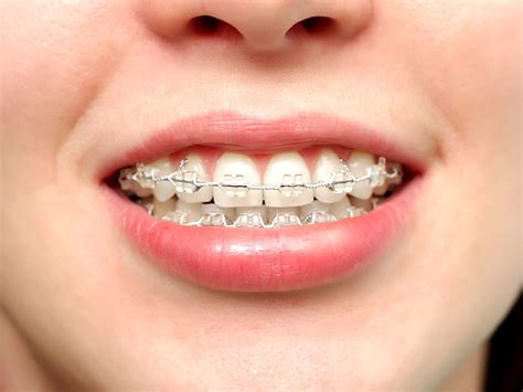 Orthodontics Gc Dental Clinic