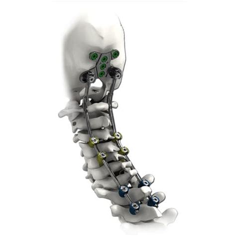 Occipito Cervico Thoracic Osteosynthesis Unit Solstice® Life Spine