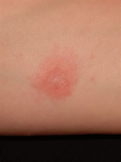 I Have A Few Dozen Red Very Itchy Bumps On Both Of My Legs I Cant Help