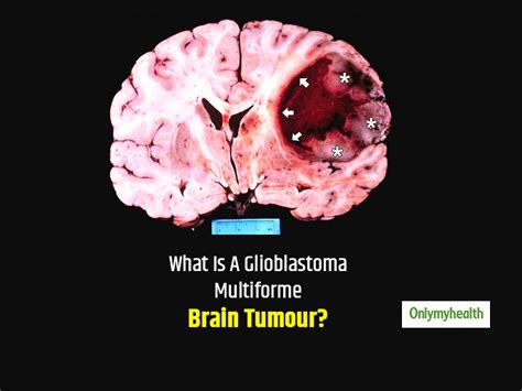 World Brain Day 2020 Causes Symptoms And Treatment Of Glioblastoma
