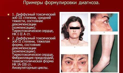 Диффузный узловой зоб диета Увеличенная щитовидная железа (эндемический зоб): симптомы и лечение Увеличенная щитовидная железа (эндемический зоб): симптомы и лечение Диффузный узловой зоб диета
