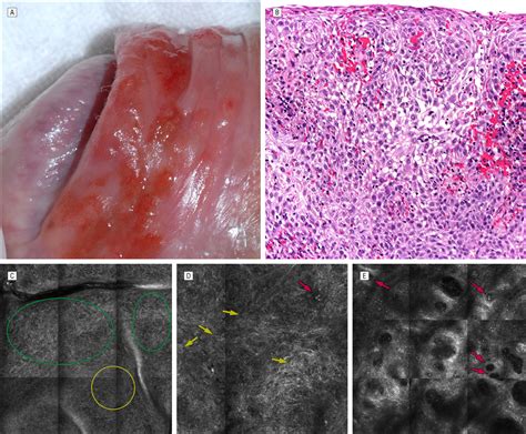 Differentiation Between Balanitis And Carcinoma In Situ Using Reflectance Confocal Microscopy