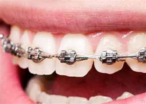 Dental genesis network dgn kuala lumpur. Conventional Braces - PrimeCare Dental Clinic Shah Alam