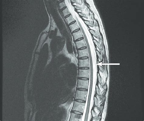 White Spots On Spine Mri
