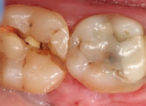 Failure to recognize a resorption case will lead anatomy of the root canal system: What To Do If Your Molar Tooth Breaks - A Complete Guide ...