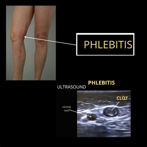 Is Phlebitis Dangerous And Life Threatening The Veincare Centre