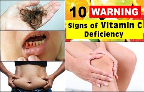 Do You Know Symptoms Of Vitamin C Deficiency Such Tv