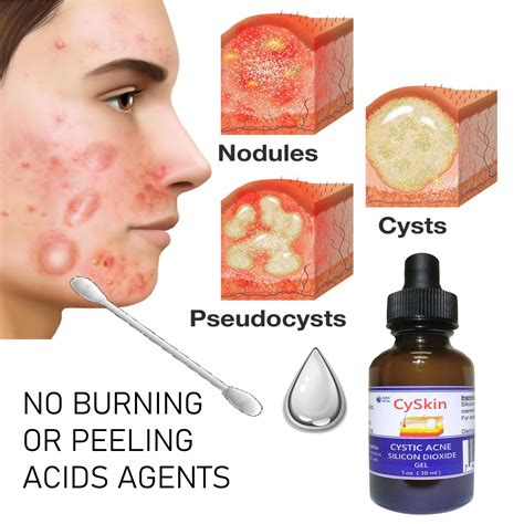Cystic Acne Skin Treatment Cyskin Silicon Dioxide Gel Etsy