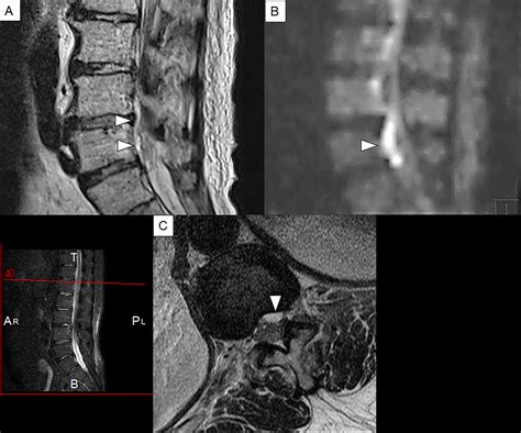 Spinal Epidural Abscess A Review Highlighting Early Diagnosis And