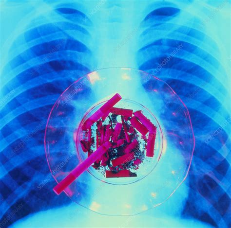 cigarettes in front of lung x ray stock image m370 0306 science photo library