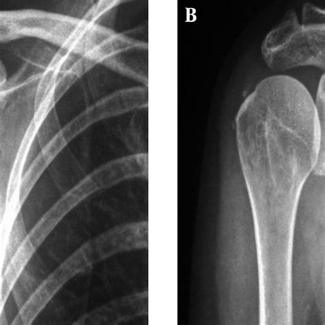 Calcifying Tendonitis And Radiological Calcification Type Resorptive Download Scientific