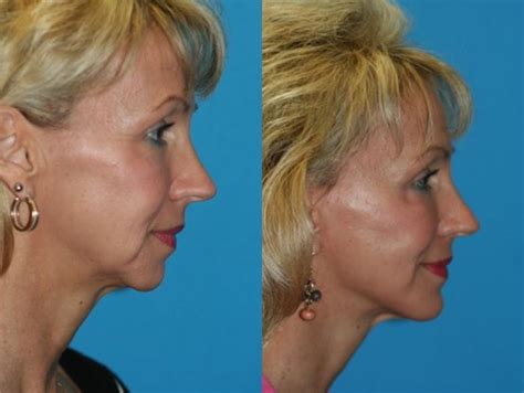 Chin Augmentation Before And After Pictures Case 40 Charleston Sc