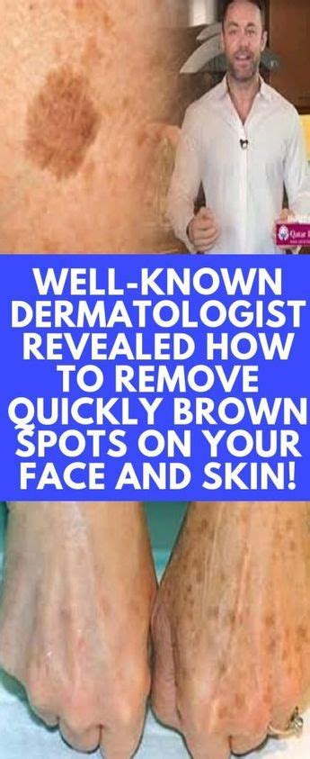 Well Known Dermatologist Revealed How To Remove Quickly Brown Spots On