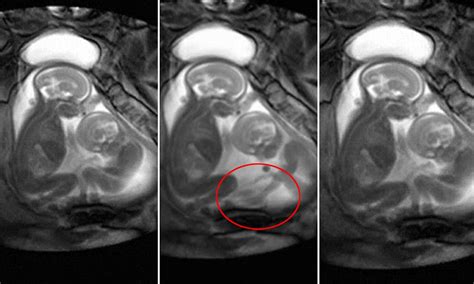 He Kicked Me First Amazing Video Captures Twins Fighting Inside The Womb Daily Mail Online