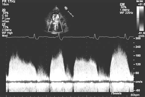 Prosthetic Tricuspid Valve Thrombosis Treated Successfully With