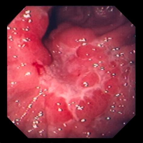 The pain may come and go. Stomach Cancer - Gastrointestinal Disorders - MSD Manual ...
