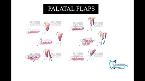 Palatal Flaps Partial Thickness Palatal Flaps Dr Ankita Kotecha