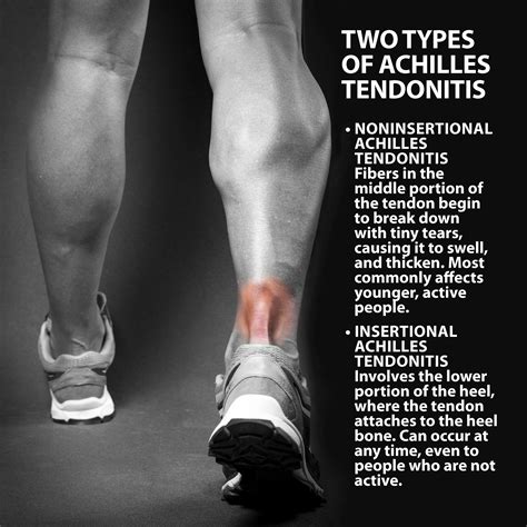 Tendonitis Pictures
