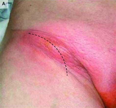 A hiatal hernia occurs when a portion of the stomach prolapses through the diaphragmatic esophageal hiatus. Femoral Region and Hernias | Concise Medical Knowledge