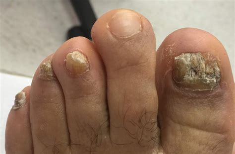 About Toenail Fungus Before And After Images