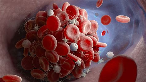 Why Clotting Happens When Platelets Are Low Medpage Today