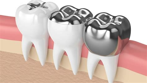 Gold And Amalgam Fillings Westerville Dental Associates