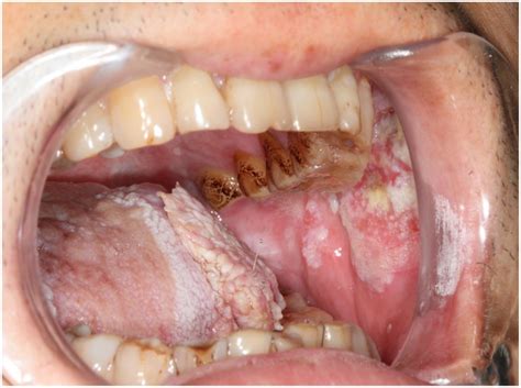 But, as a rule, this. Note that the left tongue cancer (T3N0M0) and left buccal ...