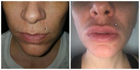 Kelly Before And After Lip Injections Majestic Beauty Spa Pllc