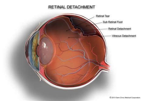 Torn Retina Ophthalmoscopy View Of Torn Retina In Eye Photograph By