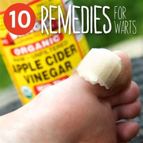 10 Common Remedies To Get Rid Of Warts Home Remedies For Warts Warts