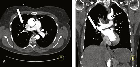 Intravenous Contrast Material Administration At High Pitch Dual Source