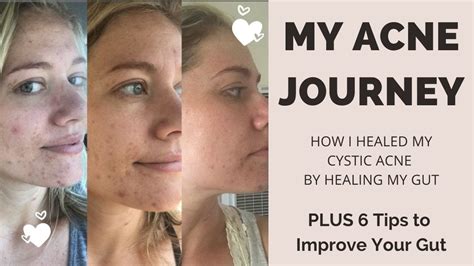 My Acne Journey How I Healed My Cystic Acne By Healing My Gut Plus Tips To Improve Your Gut