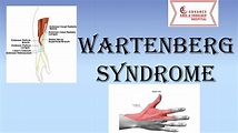 Wartenberg Syndrome : Superficial Radial Nerve Compression Neuropathy ...
