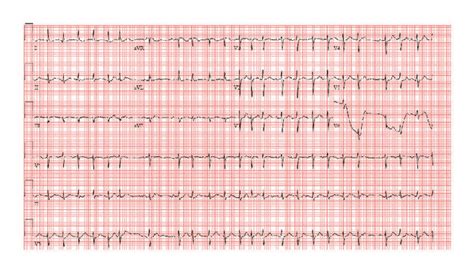 Ecg In The Telemetry Unit Demonstrating Tachycardia With An Irregular