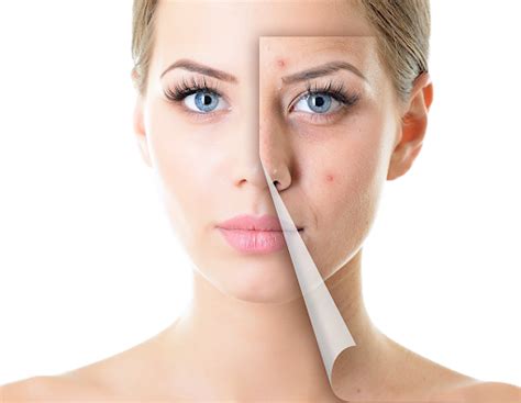 Acne Treatment And Scar Removal Clinics In Hyderabad Pelle Clinics