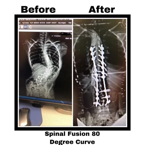14 Year Old Spinal Fusion Surgery Before And After 80 Degree Lumbar