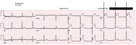 Dr Smith S Ecg Blog Best Explanation Of Terminal Qrs Distortion In
