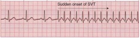 Psvt Paroxysmal Supraventricular Tachycardia Psvt Causes