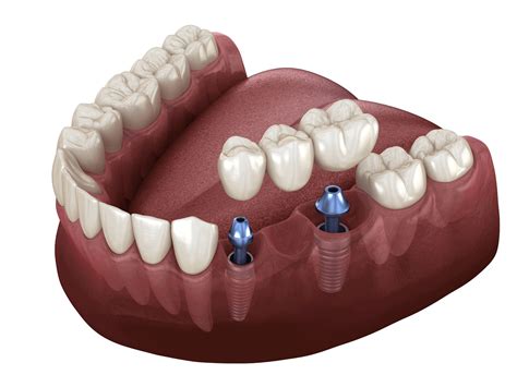 Dental Implants Near Me - Bright32