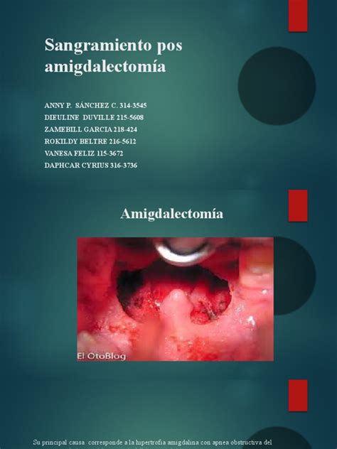 Sangramiento Pos Amigdalectomía Pdf Vómitos Neumonía