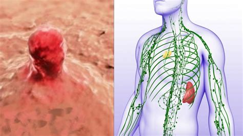 The Lymph System Allows Cancer To Spread These Are The 9 Ways To Stop