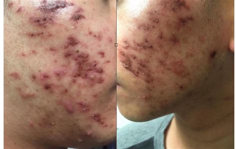 Extreme Cystic Acne Facial Aftermath Is This Normal Acne