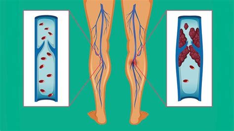 Blood Clot In Foot Symptoms And Signs - Signs And Symptoms Of Blood ...