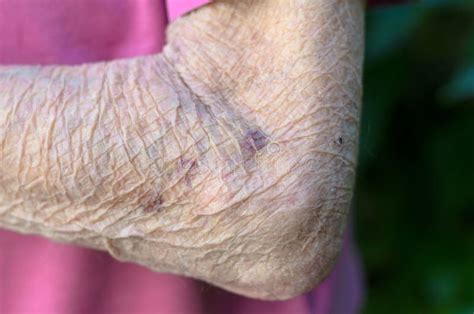 Very Wrinkled Arm And Elbow Of An Old Person Stock Image Image Of