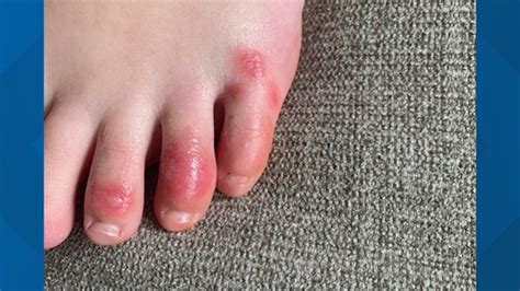 What Are Covid Toes Skin Condition May Be Linked To Coronavirus
