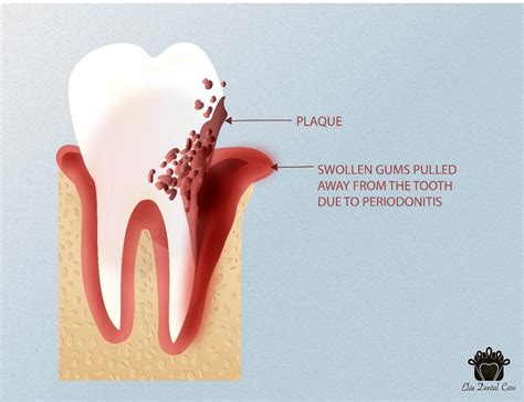 why is it important to treat periodontitis disease elite dental care tracy